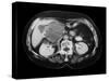 Cystic Pancreas Tumour, CT Scan-ZEPHYR-Stretched Canvas