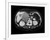 Cystic Pancreas Tumour, CT Scan-ZEPHYR-Framed Photographic Print