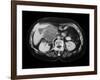 Cystic Pancreas Tumour, CT Scan-ZEPHYR-Framed Photographic Print