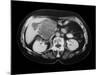 Cystic Pancreas Tumour, CT Scan-ZEPHYR-Mounted Photographic Print