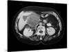 Cystic Pancreas Tumour, CT Scan-ZEPHYR-Stretched Canvas