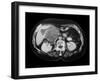 Cystic Pancreas Tumour, CT Scan-ZEPHYR-Framed Photographic Print