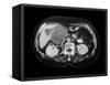 Cystic Pancreas Tumour, CT Scan-ZEPHYR-Framed Stretched Canvas