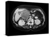 Cystic Pancreas Tumour, CT Scan-ZEPHYR-Stretched Canvas
