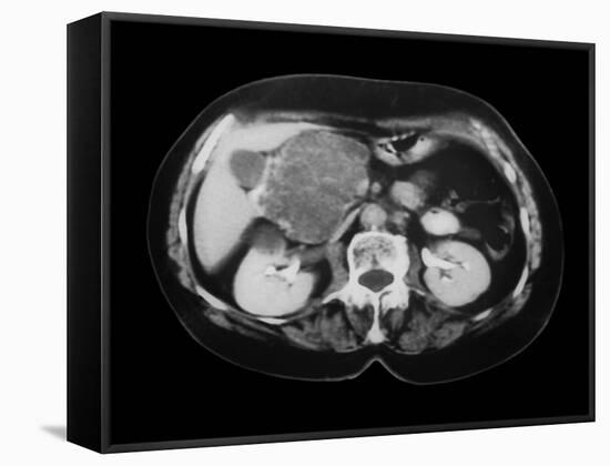 Cystic Pancreas Tumour, CT Scan-ZEPHYR-Framed Stretched Canvas