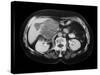 Cystic Pancreas Tumour, CT Scan-ZEPHYR-Stretched Canvas