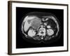 Cystic Pancreas Tumour, CT Scan-ZEPHYR-Framed Photographic Print