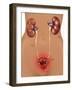 Cystitis (Bladder Infection)-Gwen Shockey-Framed Giclee Print