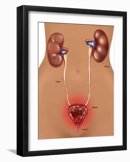 Cystitis (Bladder Infection)-Gwen Shockey-Framed Giclee Print