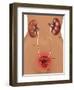 Cystitis (Bladder Infection)-Gwen Shockey-Framed Giclee Print