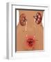 Cystitis (Bladder Infection)-Gwen Shockey-Framed Giclee Print