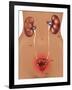 Cystitis (Bladder Infection)-Gwen Shockey-Framed Giclee Print