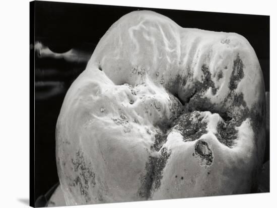 Decay on Molar Tooth, SEM-David McCarthy-Stretched Canvas