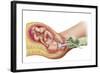 Delivery of Fetus Using Vacuum Extraction Due to Shoulder Dystocia-null-Framed Art Print