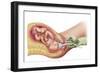 Delivery of Fetus Using Vacuum Extraction Due to Shoulder Dystocia-null-Framed Art Print