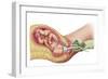 Delivery of Fetus Using Vacuum Extraction Due to Shoulder Dystocia-null-Framed Art Print