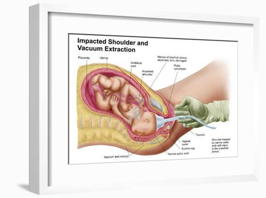 Delivery of Fetus Using Vacuum Extraction Due to Shoulder Dystocia-null-Framed Art Print