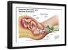 Delivery of Fetus Using Vacuum Extraction Due to Shoulder Dystocia-null-Framed Art Print