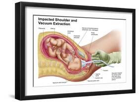 Delivery of Fetus Using Vacuum Extraction Due to Shoulder Dystocia-null-Framed Art Print