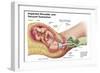 Delivery of Fetus Using Vacuum Extraction Due to Shoulder Dystocia-null-Framed Art Print