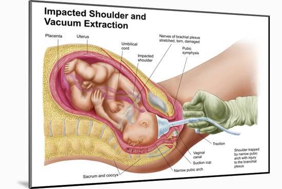 Delivery of Fetus Using Vacuum Extraction Due to Shoulder Dystocia-null-Mounted Art Print