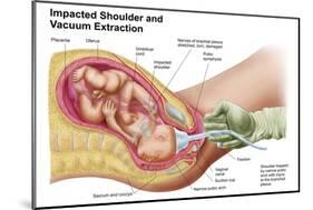 Delivery of Fetus Using Vacuum Extraction Due to Shoulder Dystocia-null-Mounted Art Print