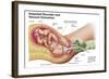 Delivery of Fetus Using Vacuum Extraction Due to Shoulder Dystocia-null-Framed Art Print