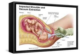 Delivery of Fetus Using Vacuum Extraction Due to Shoulder Dystocia-null-Framed Stretched Canvas