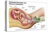 Delivery of Fetus Using Vacuum Extraction Due to Shoulder Dystocia-null-Stretched Canvas