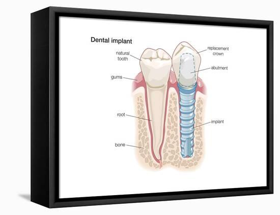 Dental Crown. Dentistry, Endodontics, Teeth, Tooth Damage, Oral Health, Health and Disease-Encyclopaedia Britannica-Framed Stretched Canvas