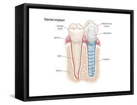 Dental Crown. Dentistry, Endodontics, Teeth, Tooth Damage, Oral Health, Health and Disease-Encyclopaedia Britannica-Framed Stretched Canvas