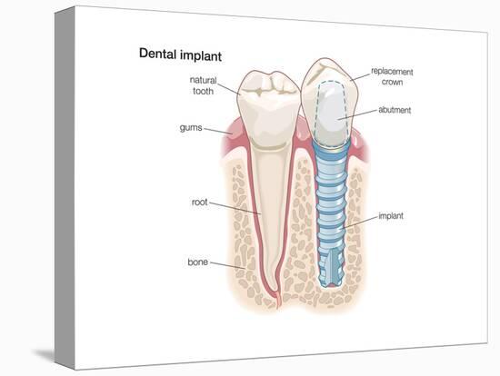 Dental Crown. Dentistry, Endodontics, Teeth, Tooth Damage, Oral Health, Health and Disease-Encyclopaedia Britannica-Stretched Canvas