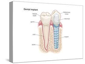 Dental Crown. Dentistry, Endodontics, Teeth, Tooth Damage, Oral Health, Health and Disease-Encyclopaedia Britannica-Stretched Canvas