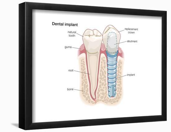 Dental Crown. Dentistry, Endodontics, Teeth, Tooth Damage, Oral Health, Health and Disease-Encyclopaedia Britannica-Framed Poster