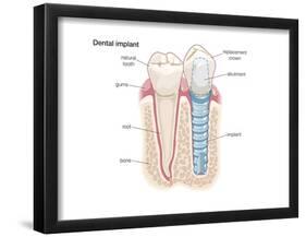 Dental Crown. Dentistry, Endodontics, Teeth, Tooth Damage, Oral Health, Health and Disease-Encyclopaedia Britannica-Framed Poster