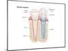 Dental Crown. Dentistry, Endodontics, Teeth, Tooth Damage, Oral Health, Health and Disease-Encyclopaedia Britannica-Mounted Poster