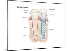Dental Crown. Dentistry, Endodontics, Teeth, Tooth Damage, Oral Health, Health and Disease-Encyclopaedia Britannica-Mounted Poster