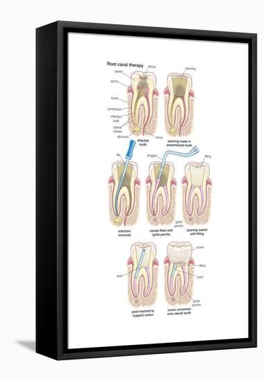 Dental Implant. Dentistry, Endodontics, Teeth, Tooth Damage, Oral Health, Health and Disease-Encyclopaedia Britannica-Framed Stretched Canvas