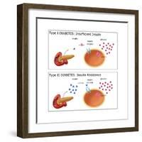 Diabetes I & II-Monica Schroeder-Framed Art Print