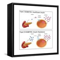 Diabetes I & II-Monica Schroeder-Framed Stretched Canvas