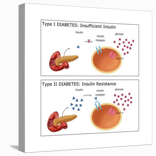 Diabetes I & II-Monica Schroeder-Stretched Canvas