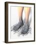 Diabetes-related Foot Problems, Artwork-David Mack-Framed Photographic Print