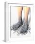 Diabetes-related Foot Problems, Artwork-David Mack-Framed Photographic Print