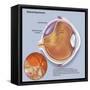 Diagram of a Retinal Detachment-null-Framed Stretched Canvas