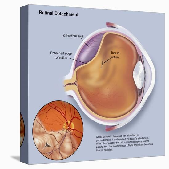 Diagram of a Retinal Detachment-null-Stretched Canvas