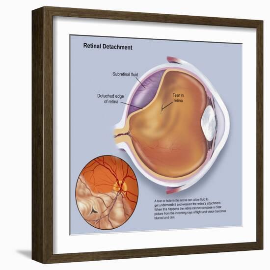 Diagram of a Retinal Detachment-null-Framed Art Print
