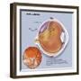 Diagram of a Retinal Detachment-null-Framed Art Print