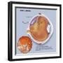 Diagram of a Retinal Detachment-null-Framed Art Print