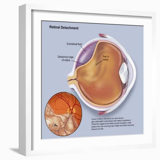 Diagram of a Retinal Detachment-null-Framed Art Print