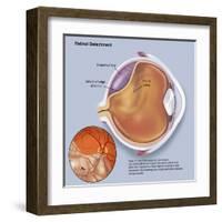 Diagram of a Retinal Detachment-null-Framed Art Print